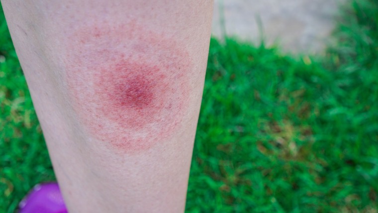Leg of a man with Lyme disease