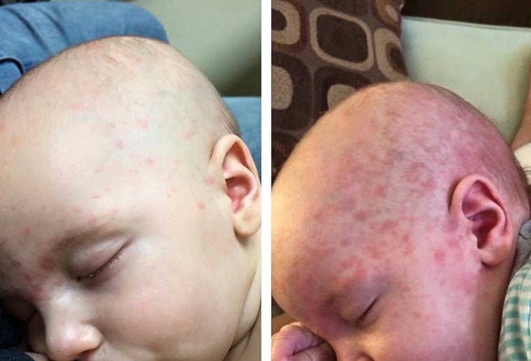 Mobius was 4 months old when he fell ill with measles after visiting Disneyland in 2015. Babies are vulnerable because they are not routinely vaccinated against the virus until they are 12 or 15 months old.