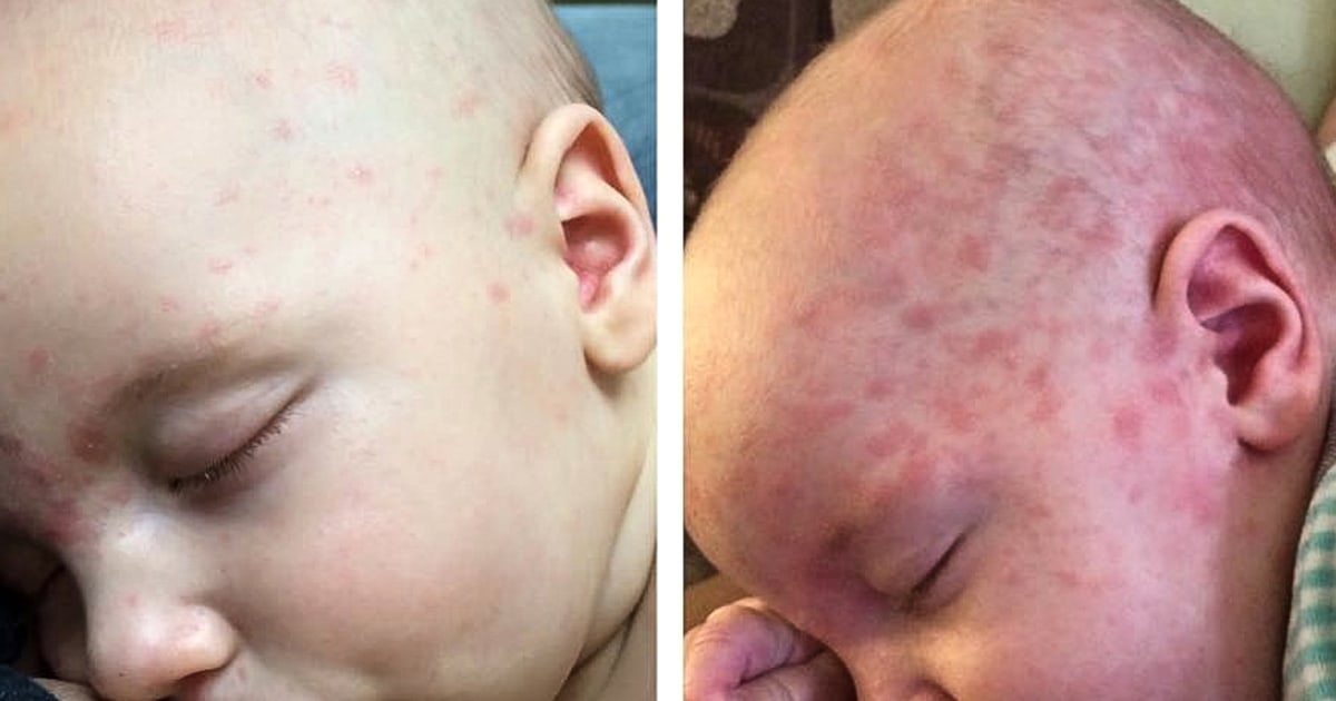 “Immunoamnesia”, pneumonia, seizures: the serious risks of measles that few know