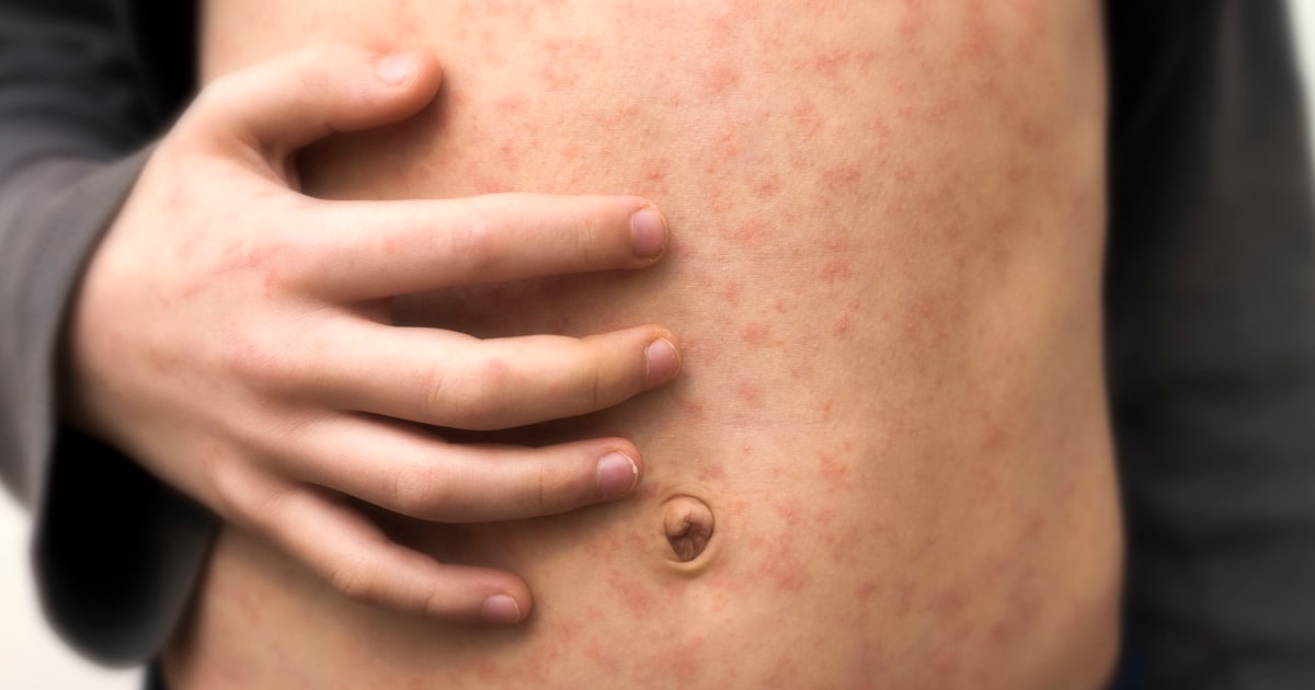 Florida defies CDC, says unvaccinated measles children can go to school amid outbreak