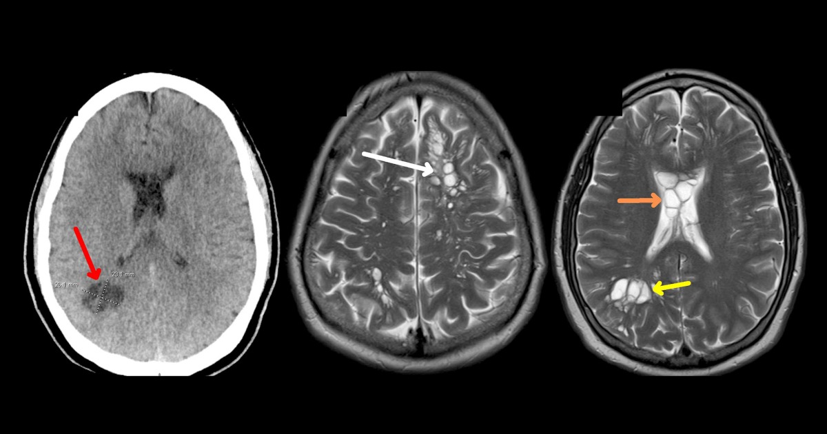 Man with migraines discovers he had tapeworms in his brain: doctors blame bacon