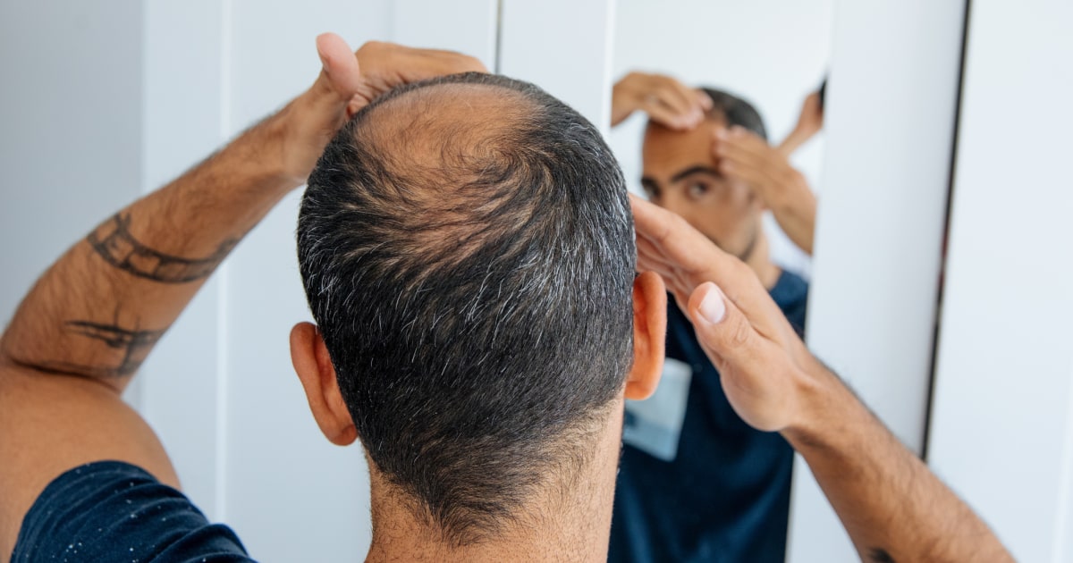 More young people use this drug to prevent hair loss, but doctors warn of side effects such as impotence